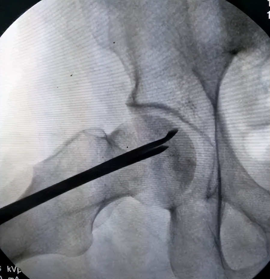 富血小板血浆因子作用,富血小板血浆治疗的目的和意义