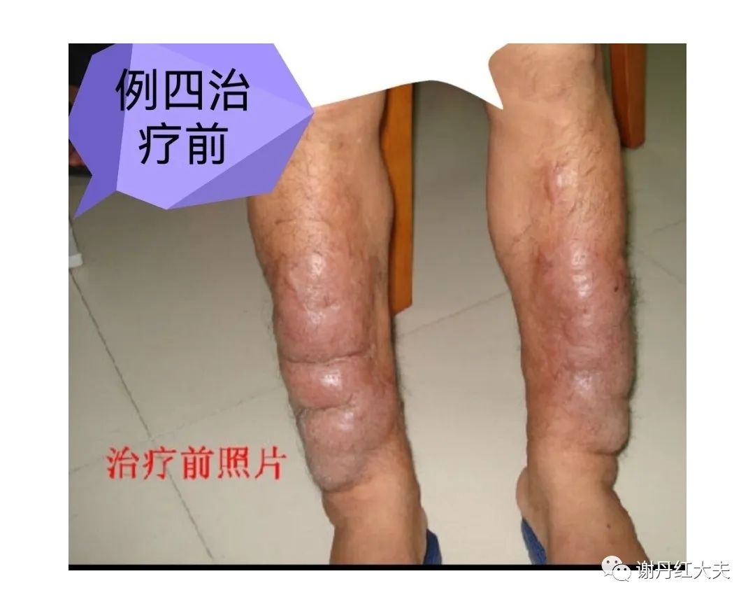 胫前黏液性水肿见于哪些病,胫前黏液性水肿为凹陷性水肿吗