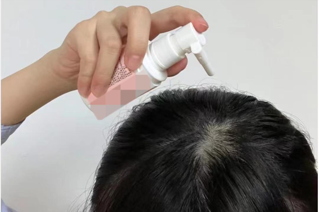 使用米诺地尔两个月长头发,使用米诺地尔五个月照片