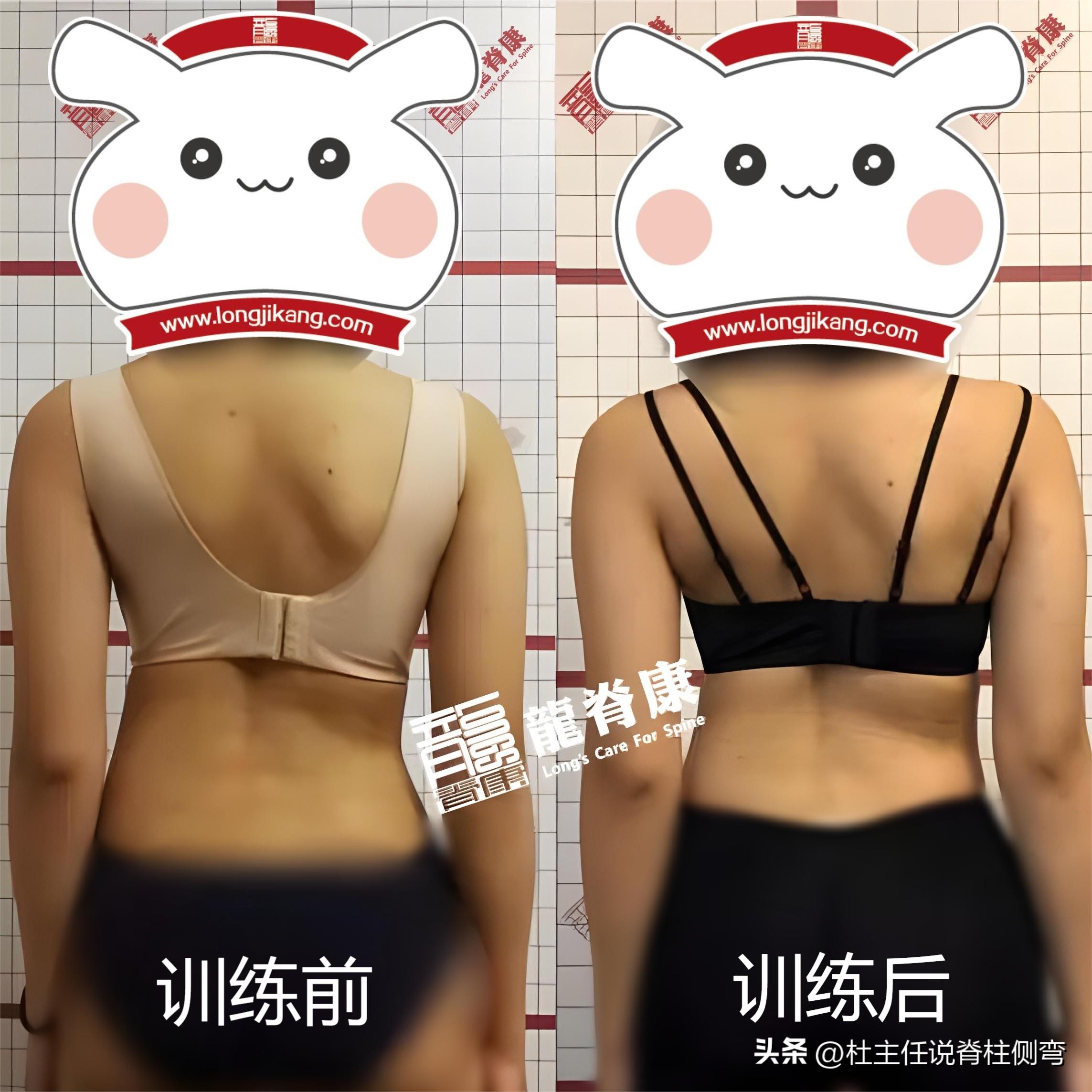 儿童侧弯10度怎么办,家长了解孩子侧弯危害性