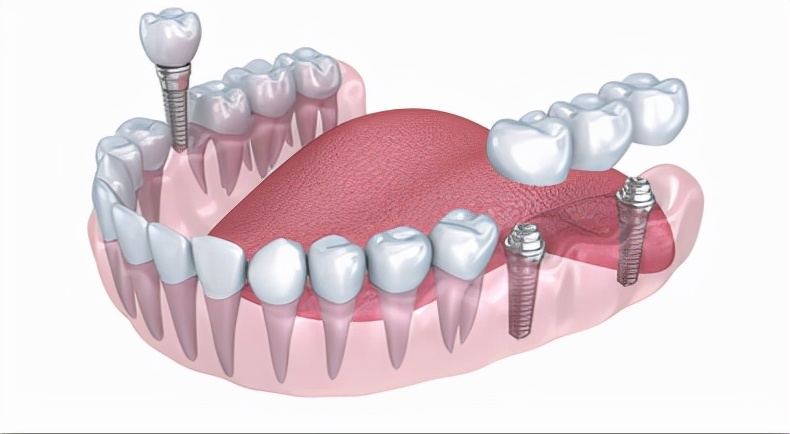 假牙的种类及价格你知道吗,假牙的种类及价格可以医保么