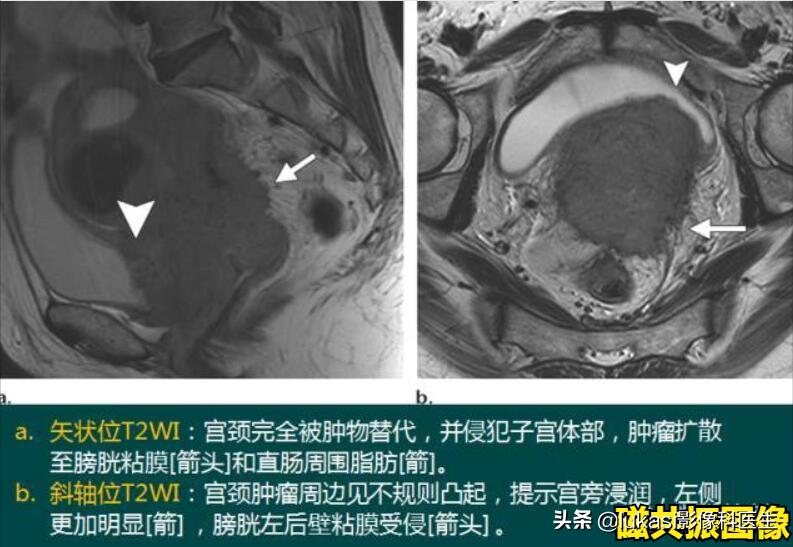 宫颈癌的可怕之处,宫颈癌日益年轻化加强筛查是重点