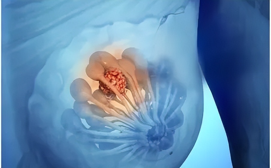 艾滋病腋下肿块,女子洗澡发现腋窝肿块