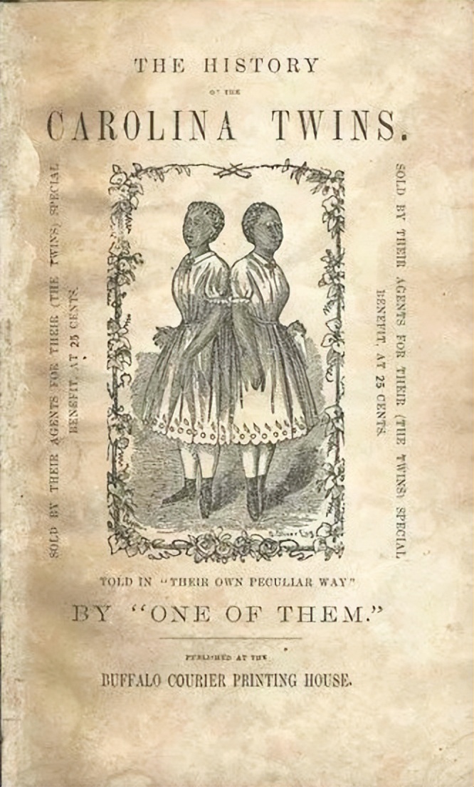 连体双胞胎姐妹的悲惨人生,双胞胎姐妹一个死亡后续