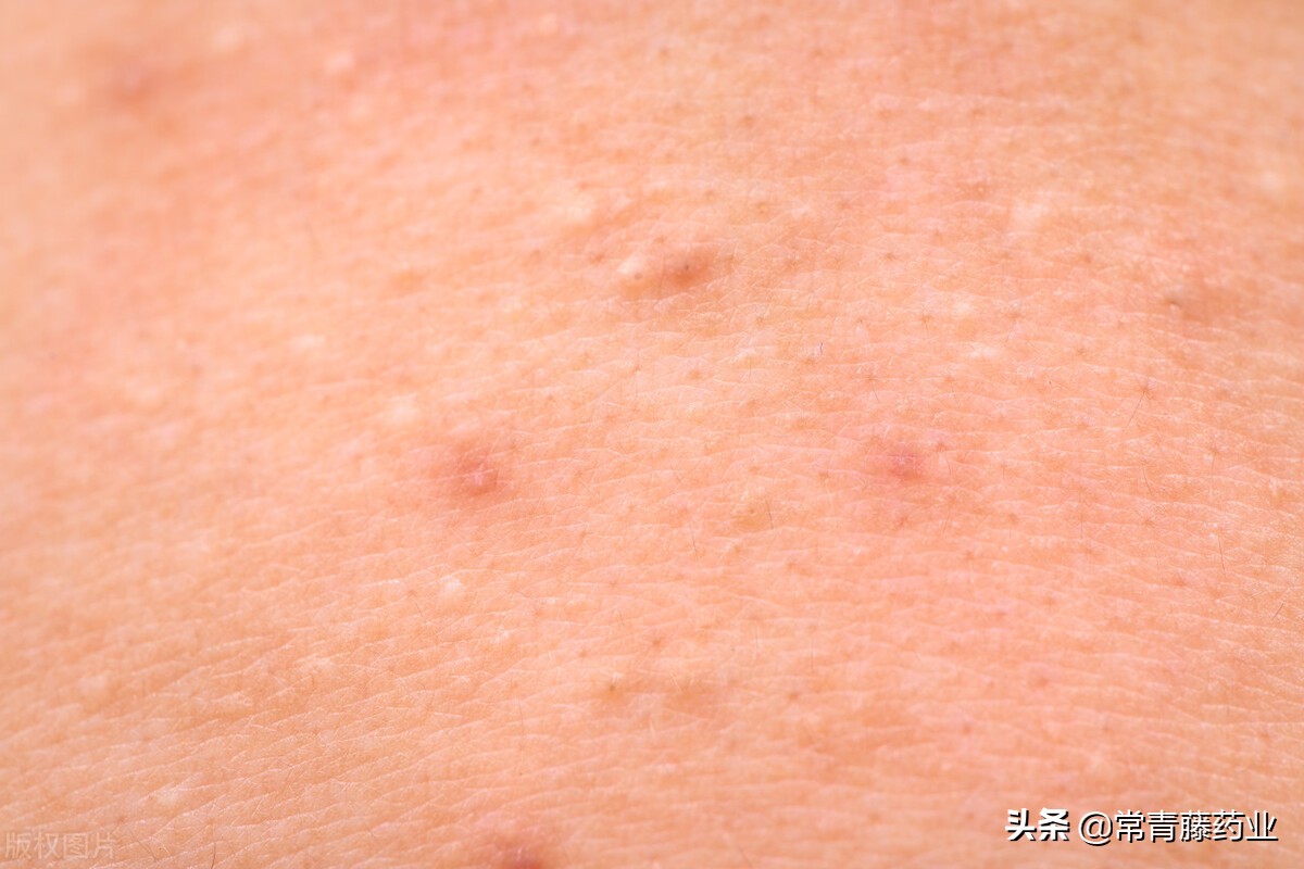 红痘印黑痘印如何快速解决,留下一大片黑红痘印怎么办