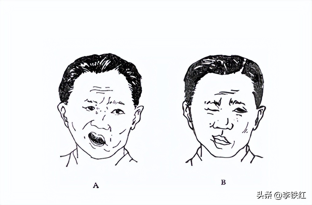 李铁红大夫：你以为面瘫是中老年人专利？4岁小孩也会患面瘫
