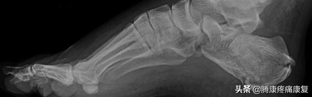 功能性高足弓的练习方式,足弓疼痛3个动作缓解