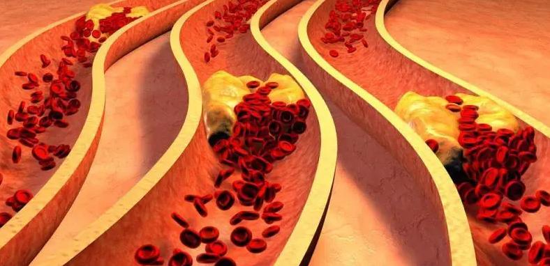 脑血栓严重会导致什么后果,脑血栓不治疗会有什么后果