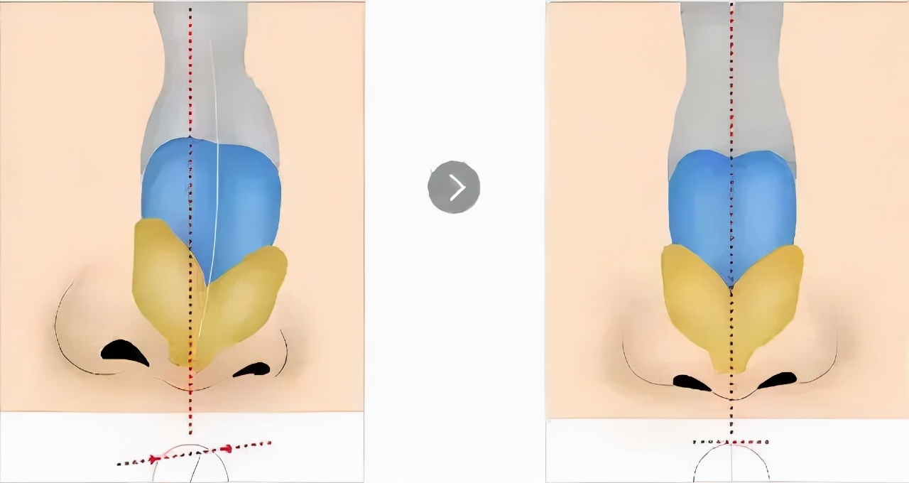 改善鼻梁歪斜的最佳方法,鼻梁不平整怎么改善