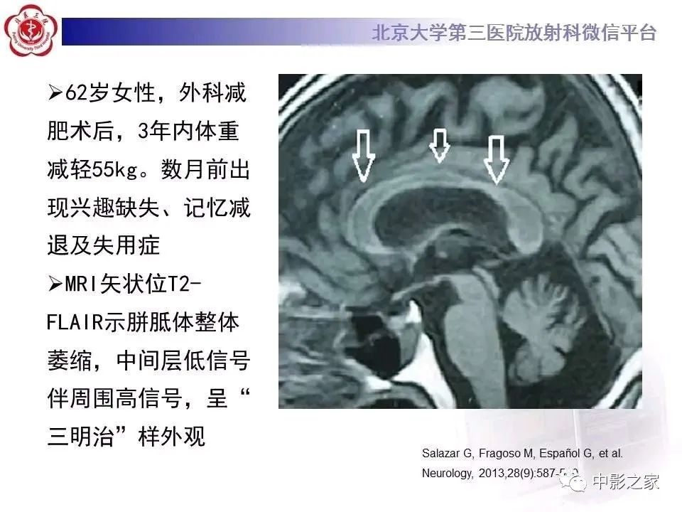 什么叫原发性胼胝体变性,原发性胼胝体变性治疗多少钱