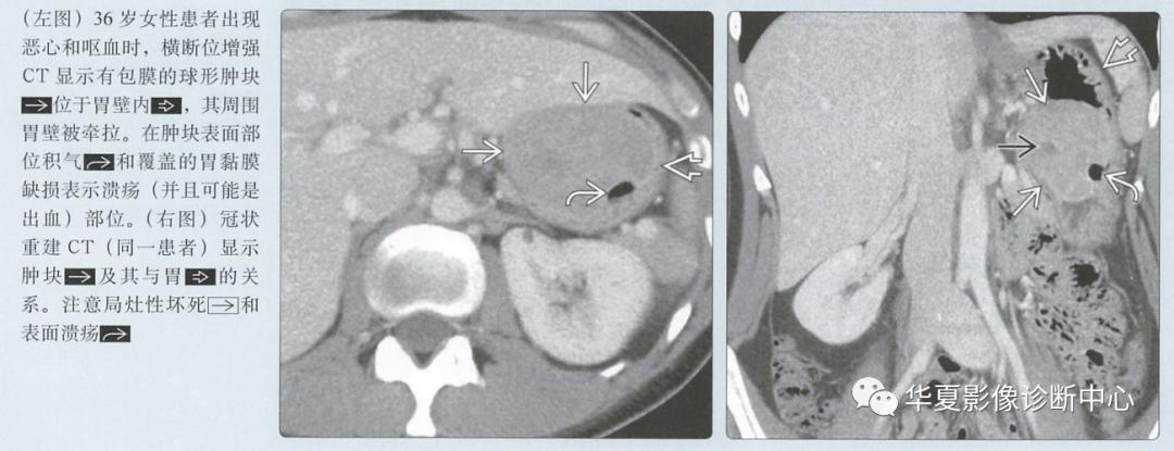 胃肠道间质瘤,胃肠间质瘤tki治疗