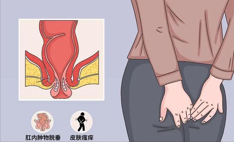 肛内尖锐性湿疣激光后怎么处理,肛周尖锐性湿疣做完激光后出血