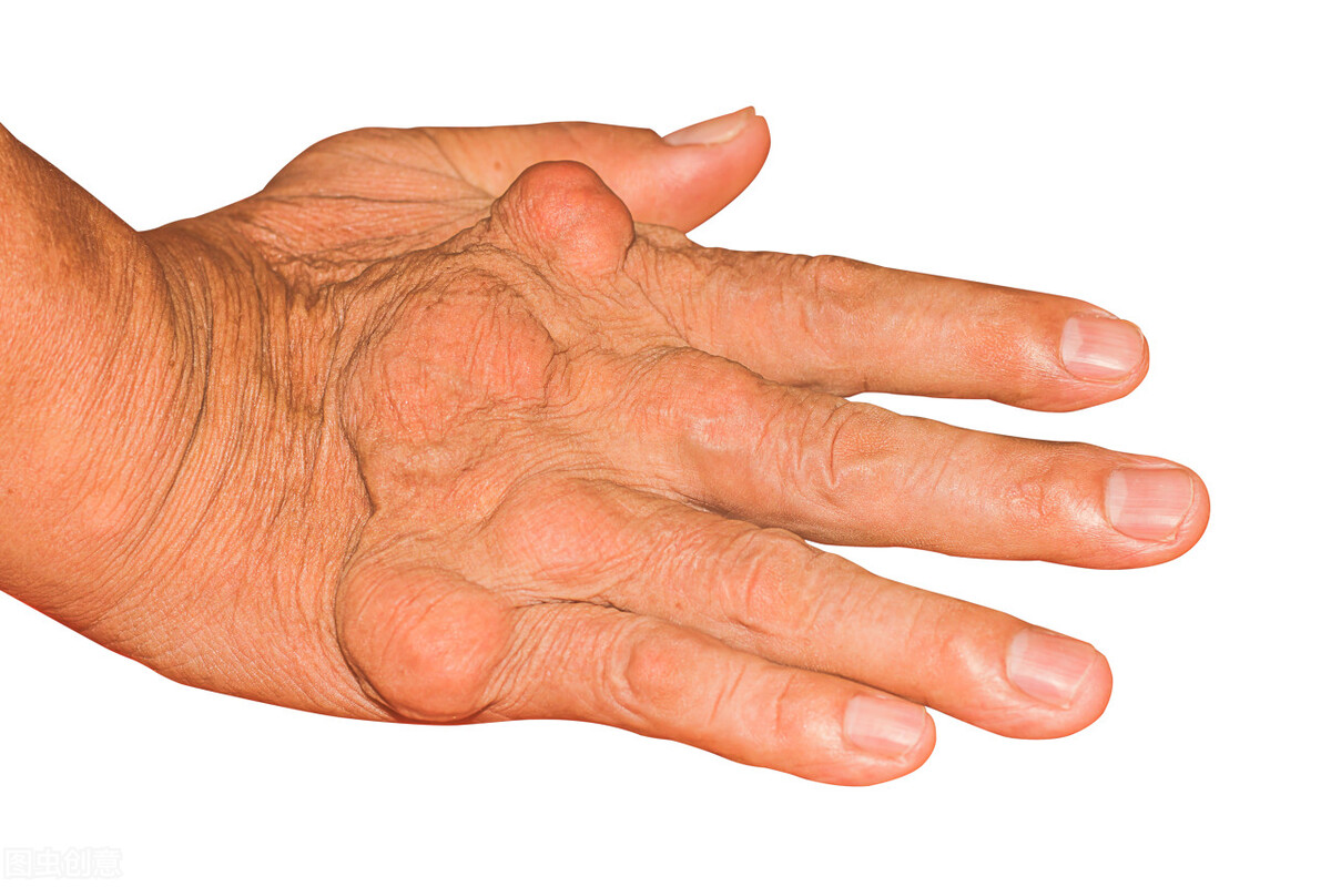 怎么可以把尿酸降下来？生活习惯对尿酸有一定的控制作用