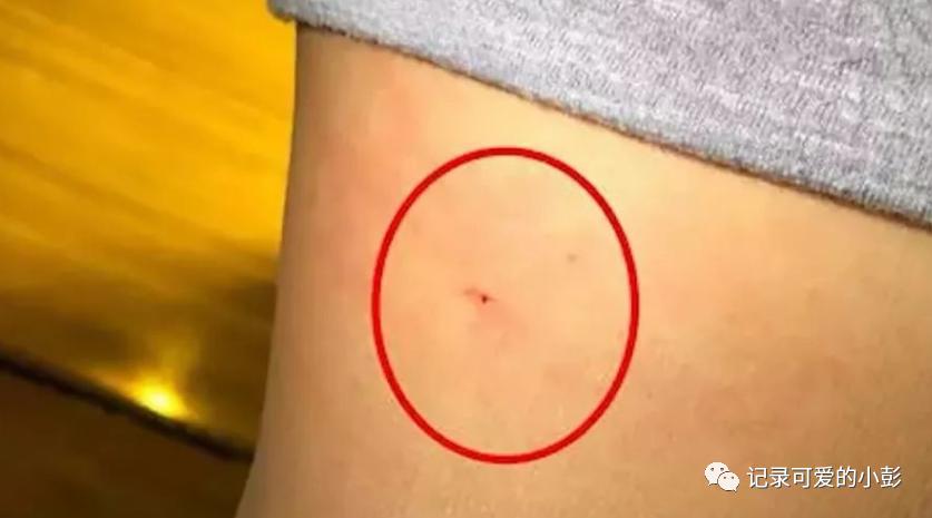 女儿下身发炎红肿怎么办,女儿下眼皮红肿