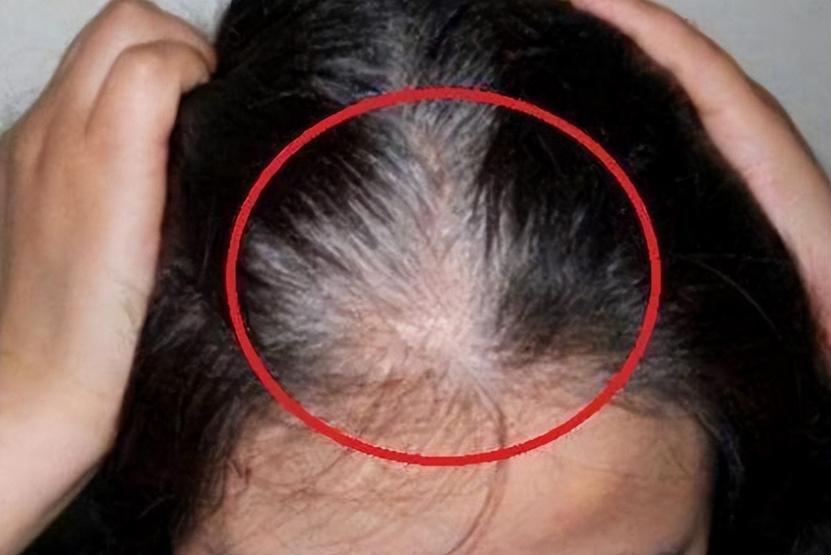 人体缺少什么营养会导致白发,缺乏哪种维生素会导致白发问题