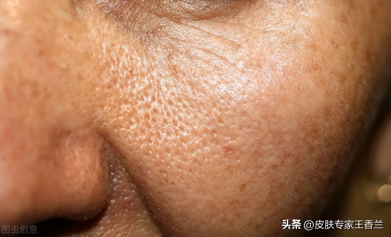 出油毛孔粗大长痘痘怎么改善,皮肤长痘油腻毛孔粗大怎么改善