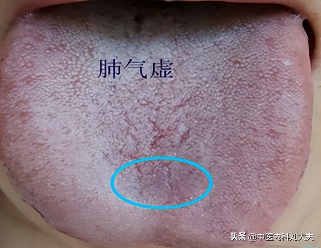 头上出汗多中医辨证,头上爱出汗食补疗法