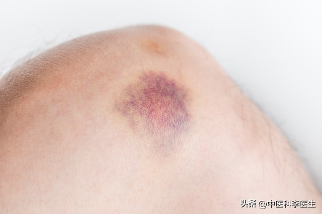 女人膝盖上的淤青怎么弄的,女人膝盖淤青