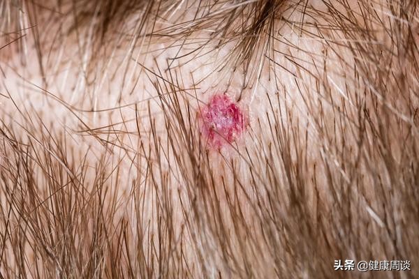 头皮痒有小疙瘩中医,头皮发痒头屑多医生建议