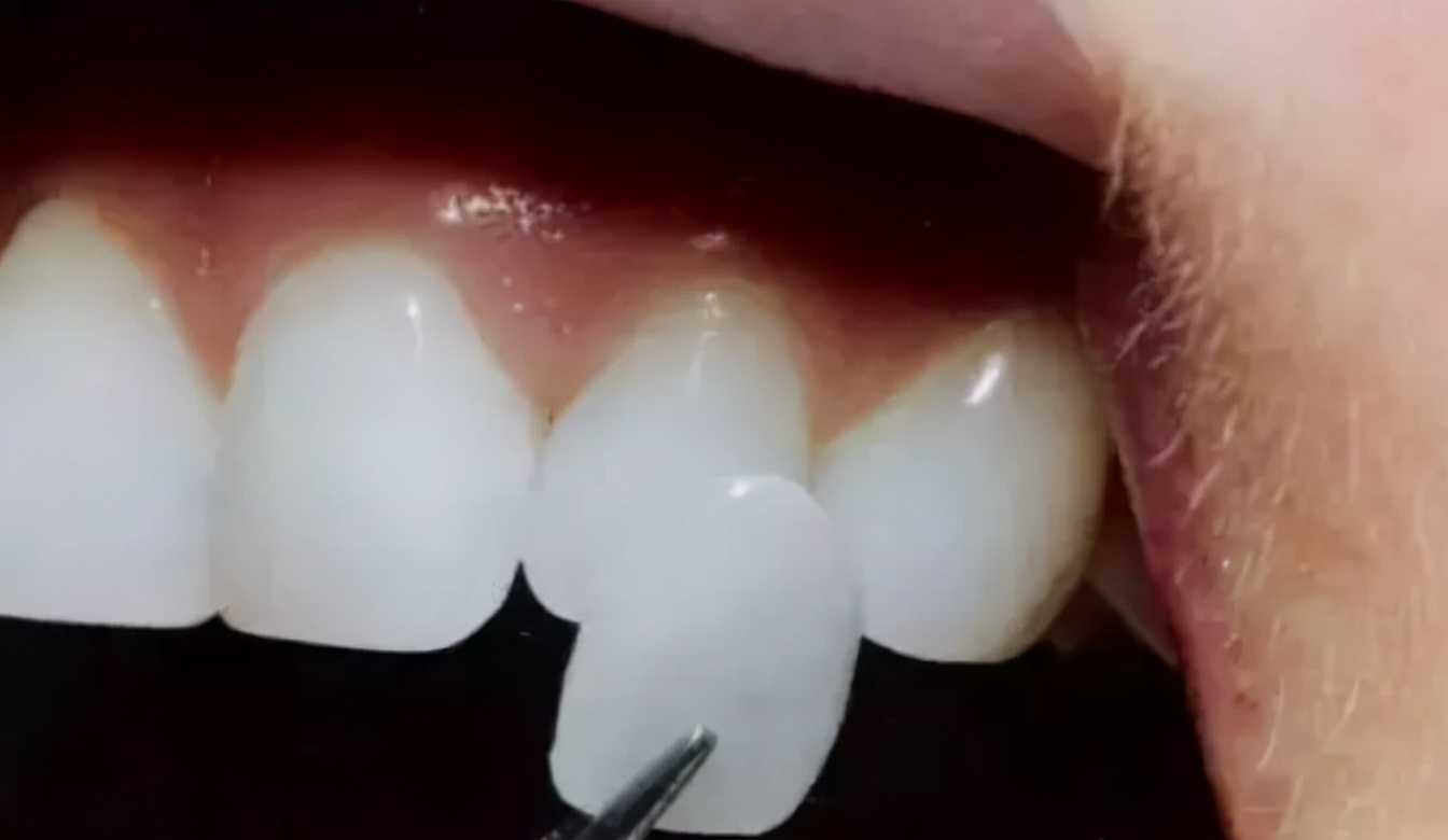 戴烤瓷牙的好处和坏处,烤瓷牙有几种它们的优缺点