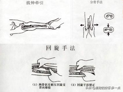 骨折复位方法您了解哪些?