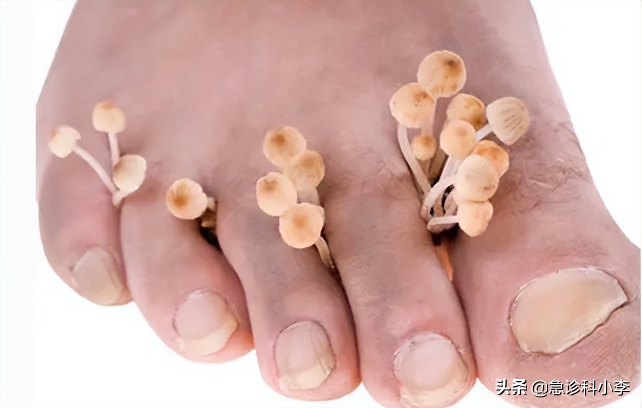 脚气反反复复怎么才能治好,脚气总是反反复复怎么治