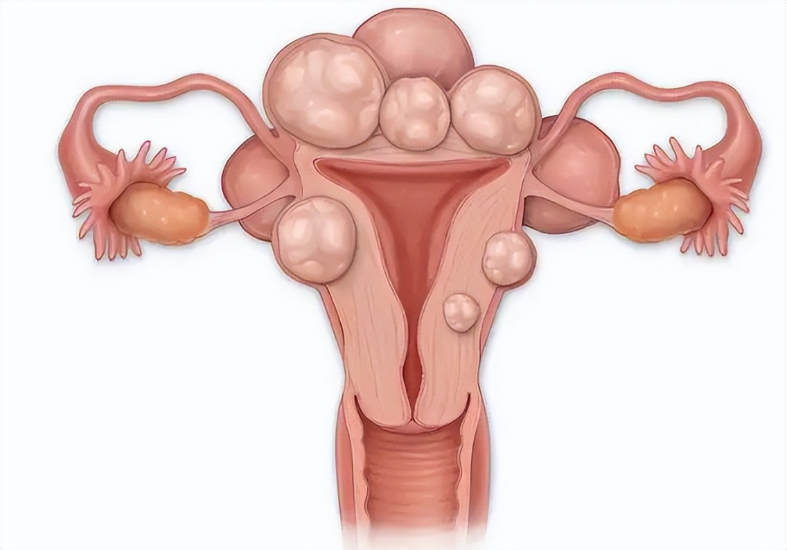 子宫巧克力囊肿是什么原因引起,子宫囊肿12x7mm要治疗吗