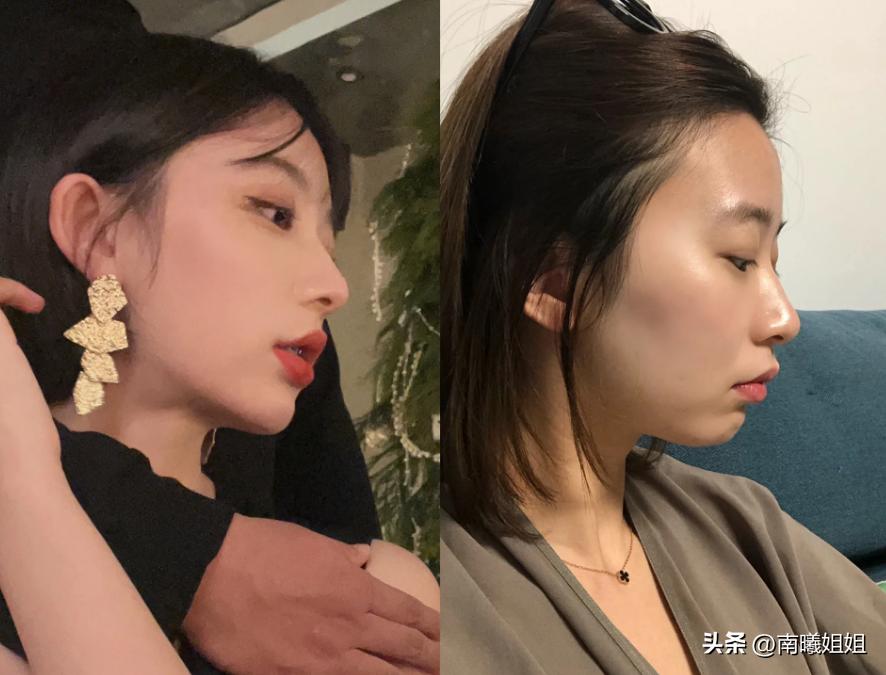 蒜头鼻却很漂亮的原因,蒜头鼻是真的影响颜值