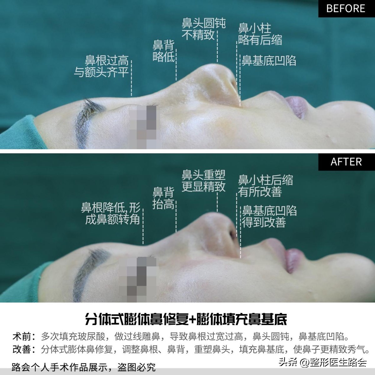 玻尿酸隆鼻立竿见影吗,玻尿酸隆鼻适合哪些鼻型