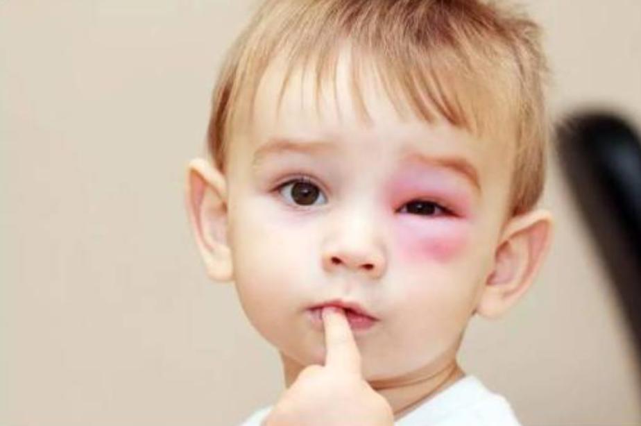 被小蜜蜂蛰了怎么缓解疼痛,被蜜蜂蛰了能挤吗