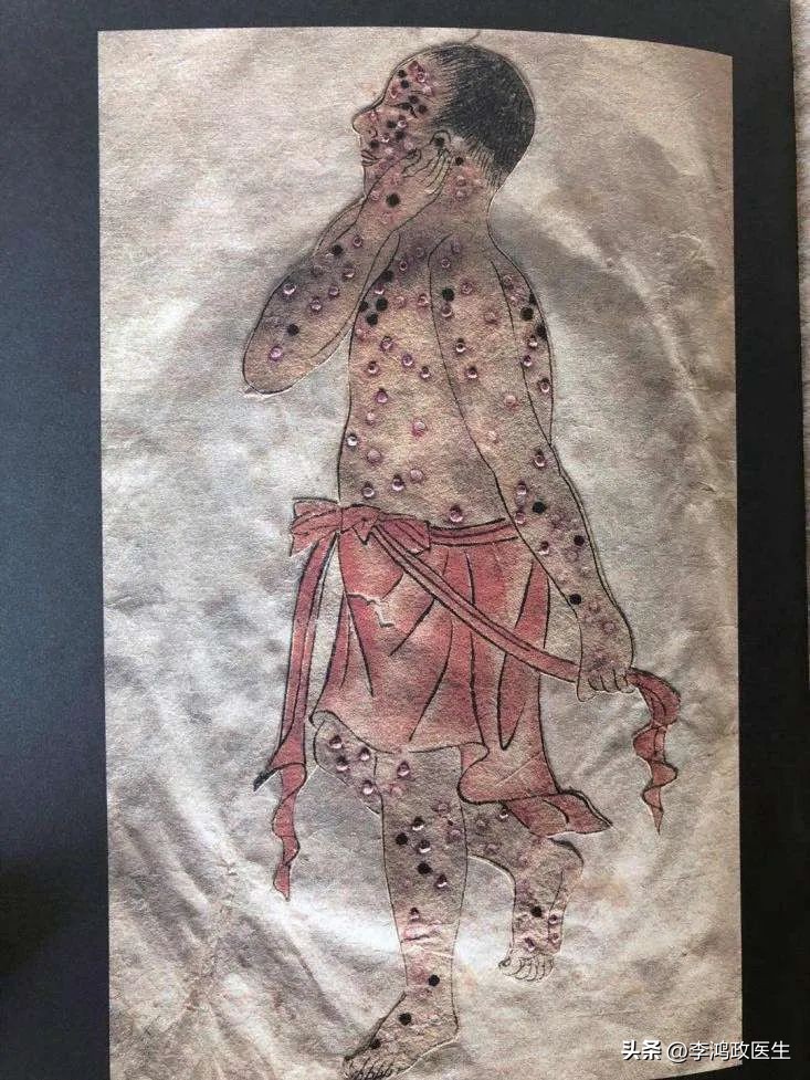 天花目前还未被人类彻底消灭吗,天花不是被灭了吗