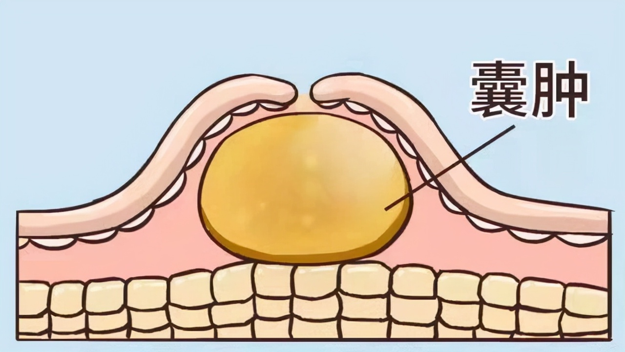 纳氏囊肿是不是就是宫颈糜烂,纳氏宫颈囊肿是什么意思