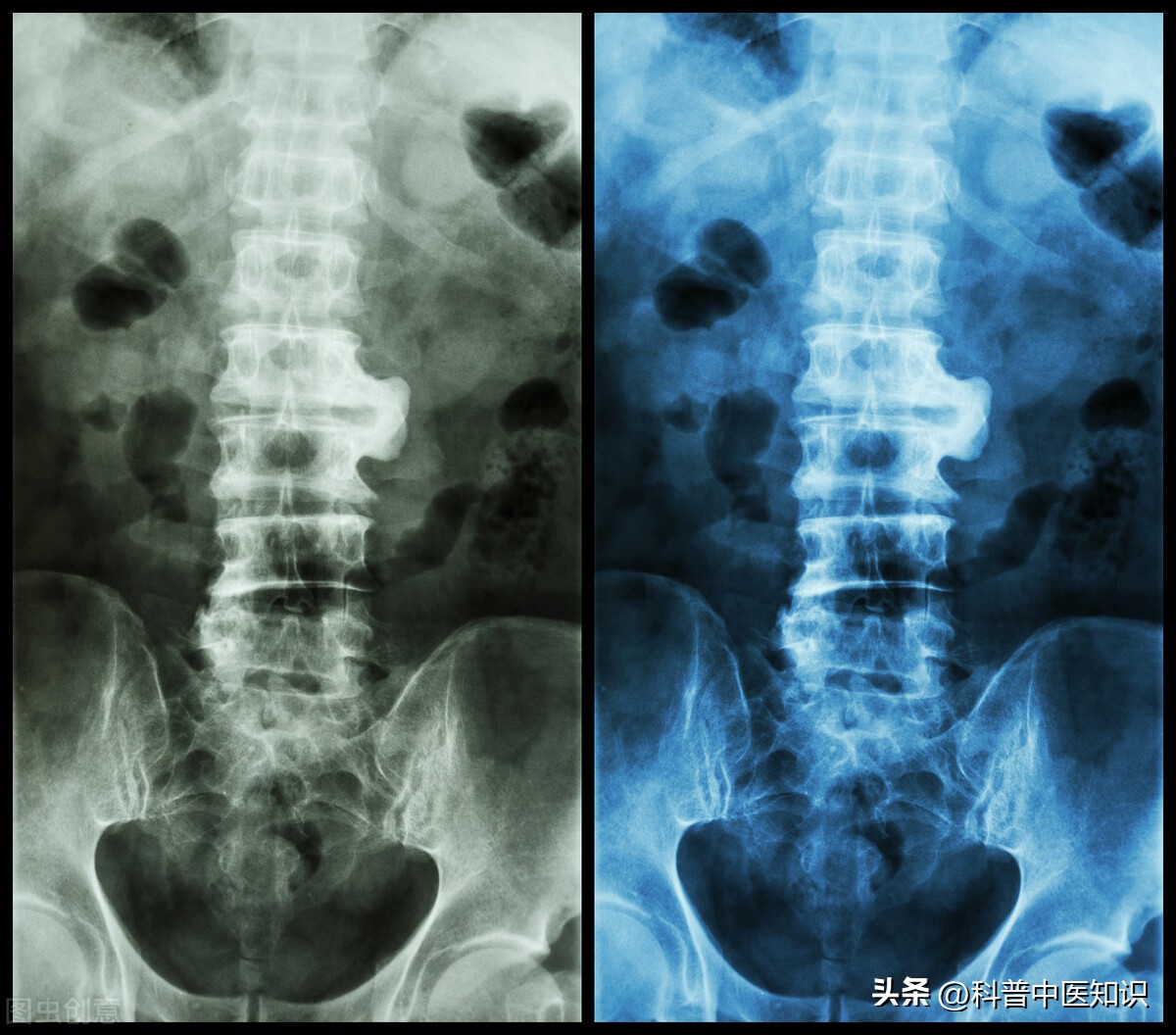 打通督脉强直性脊柱炎的中医疗法,治疗强直性脊柱炎中医还是西医好