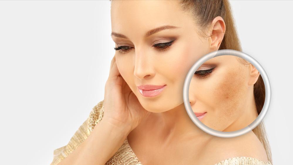 快速消除老年斑的小妙招红霉素,红霉素软膏对老年斑有治疗作用吗