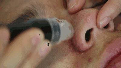 超微小气泡治疗黑头,超微小气泡清洁黑头仪