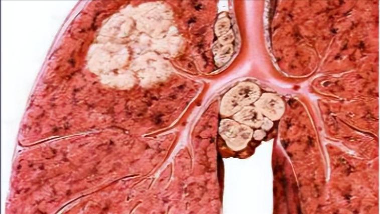 有癌腰痛是什么症状,体内有癌腰部先知