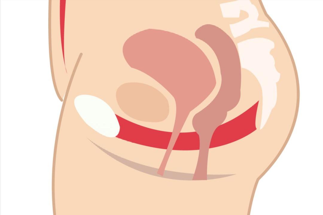 生完孩子需要做盆底肌修复吗,盆底康复治疗的适应症及禁忌症