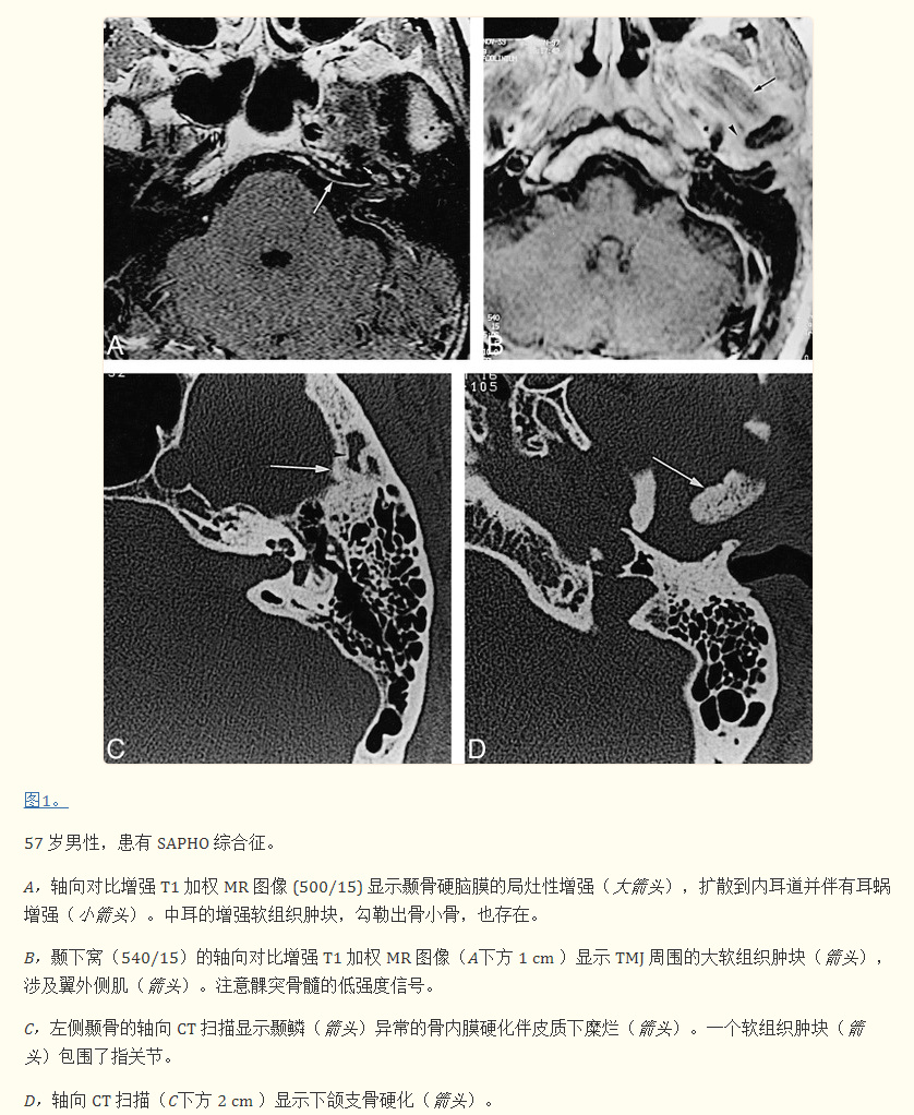 突发性耳聋眩晕综合征,突发性耳聋伴前庭功能受损