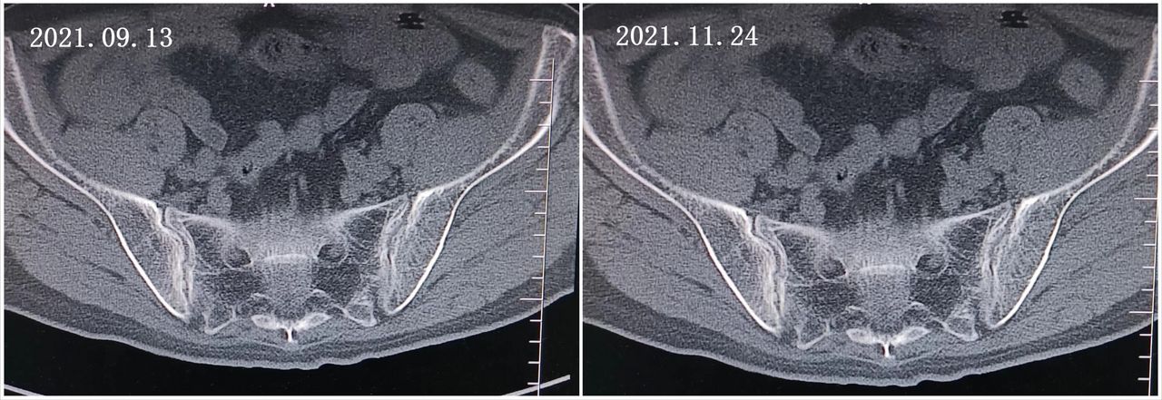 多次治疗关节疼痛效果不佳,用上阿达木单抗能改善吗?
