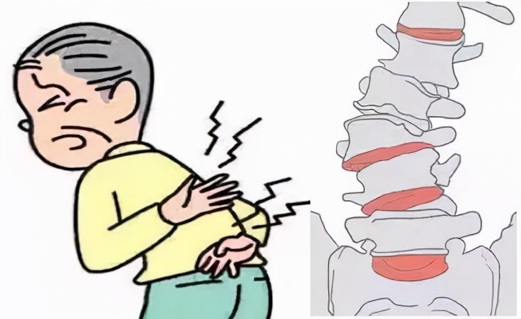 脊柱侧弯腰椎变性,70岁老人腰椎侧弯严重