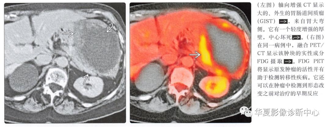 胃肠道间质瘤,胃肠间质瘤tki治疗