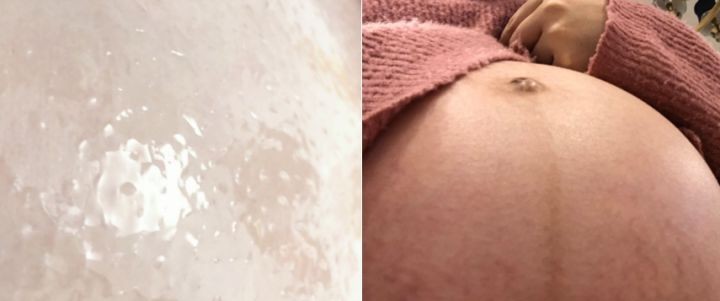 妊娠油和妊娠霜哪个更好用,妊娠纹用什么护肤霜比较好