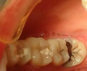 牙痛在家里没有药怎么缓解比较快,牙痛张不开嘴怎么解决