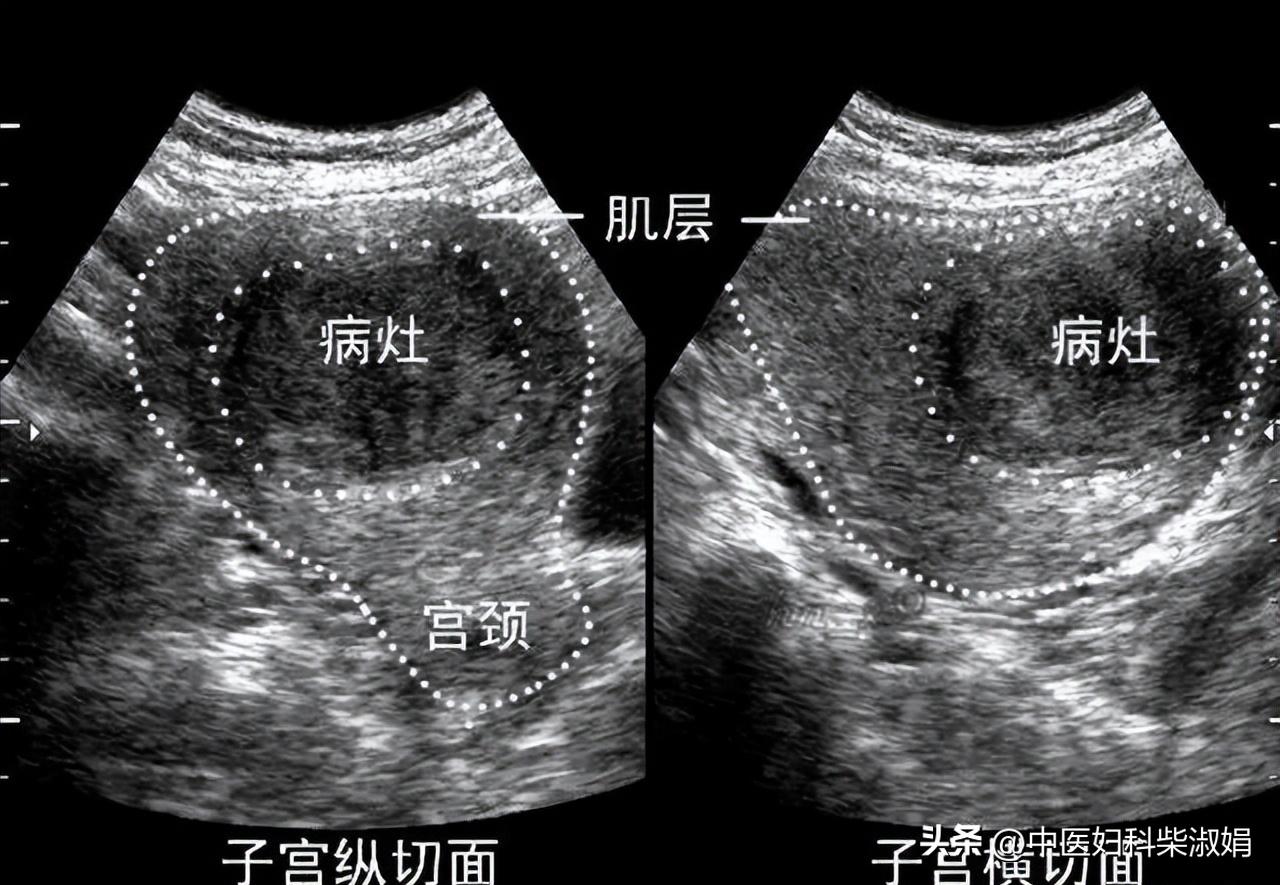 活血化瘀消除结节,中医如何散结祛瘀