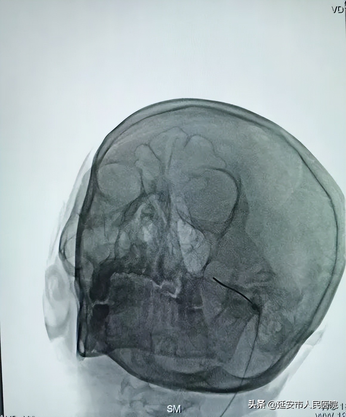 延安市人民医院疼痛康复科成功开展射频热凝术治疗三叉神经痛