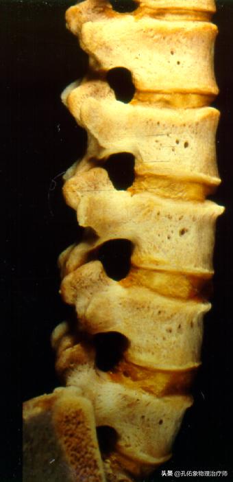 腰椎间盘突出要怎么治疗才好得快,腰椎间盘突出3个方法标本兼治