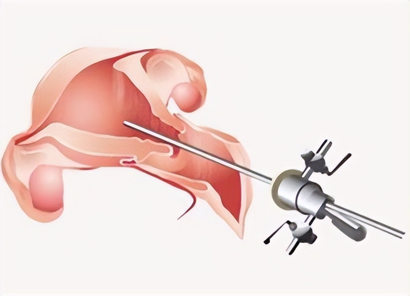 子宫内膜与妊娠,子宫内膜避孕器取出手术需要多久