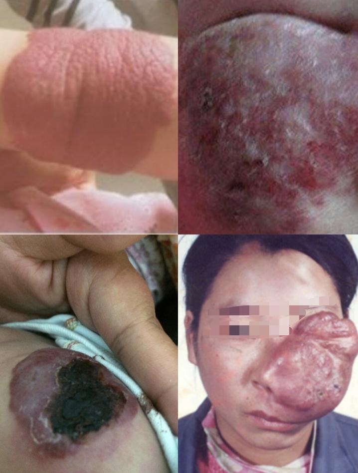 血管瘤中风险,宝宝大腿根部血管瘤手术有风险吗