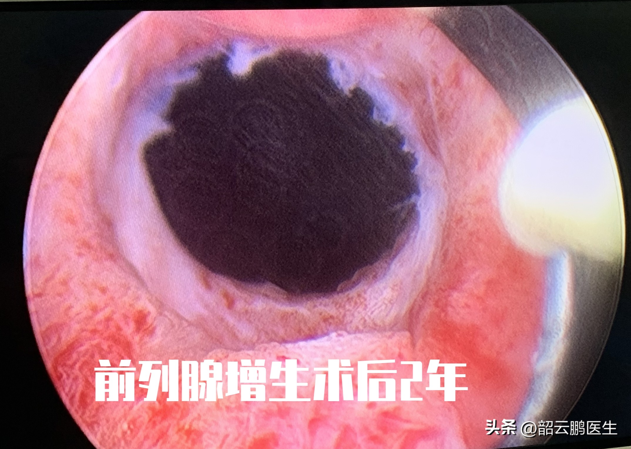 内消瘰疬丸治不治前列腺增生,前列腺增生可以做什么运动改善吗