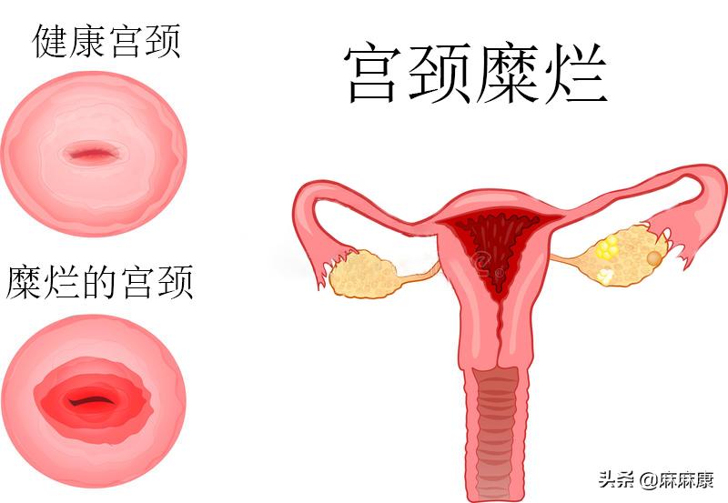 同房出血怎么办?这些措施很重要